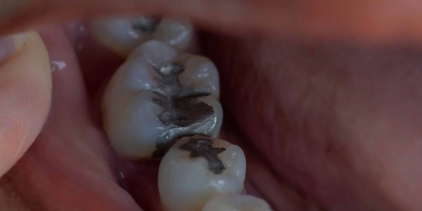 Image of Tooth Filling